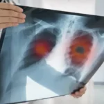 Hallada una nueva vía para potenciar la inmunoterapia en el cáncer de pulmón más agresivo