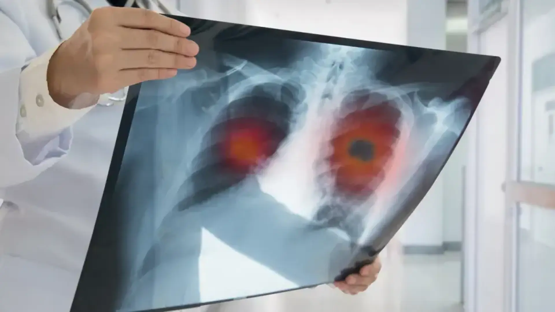 Hallada una nueva vía para potenciar la inmunoterapia en el cáncer de pulmón más agresivo