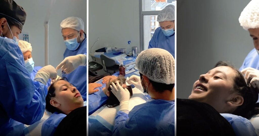 El trasplante capilar que busca devolverle el cabello a una joven que se quemó la cabeza con aceite a los dos años