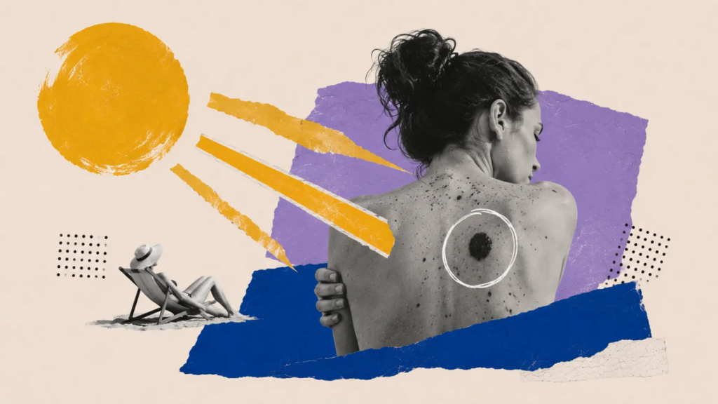 este es el riesgo de melanoma, el cáncer de piel más agresivo