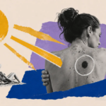 este es el riesgo de melanoma, el cáncer de piel más agresivo
