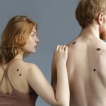 La AECC asegura que vigilar los lunares y manchas en la piel es el mejor control de los melanomas La AECC asegura que vigilar los lunares y manchas en la piel es el mejor control de los melanomas