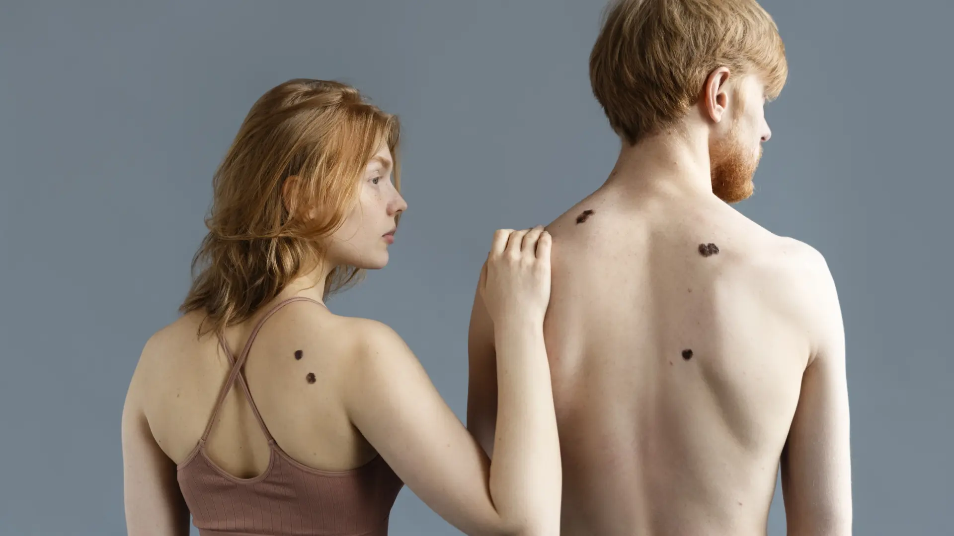 La AECC asegura que vigilar los lunares y manchas en la piel es el mejor control de los melanomas La AECC asegura que vigilar los lunares y manchas en la piel es el mejor control de los melanomas
