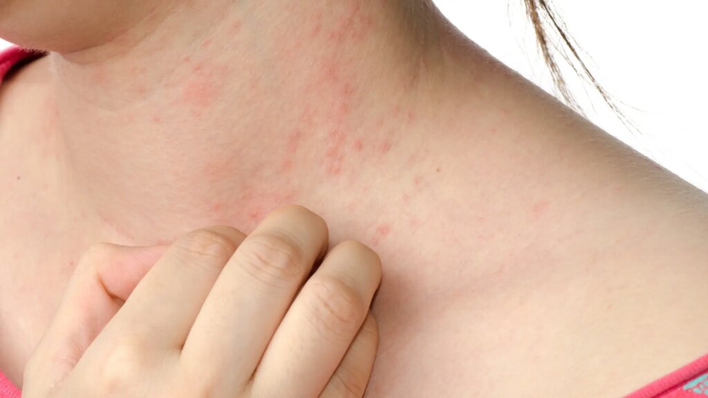 cómo prevenir esta infección dermatológica altamente contagiosa