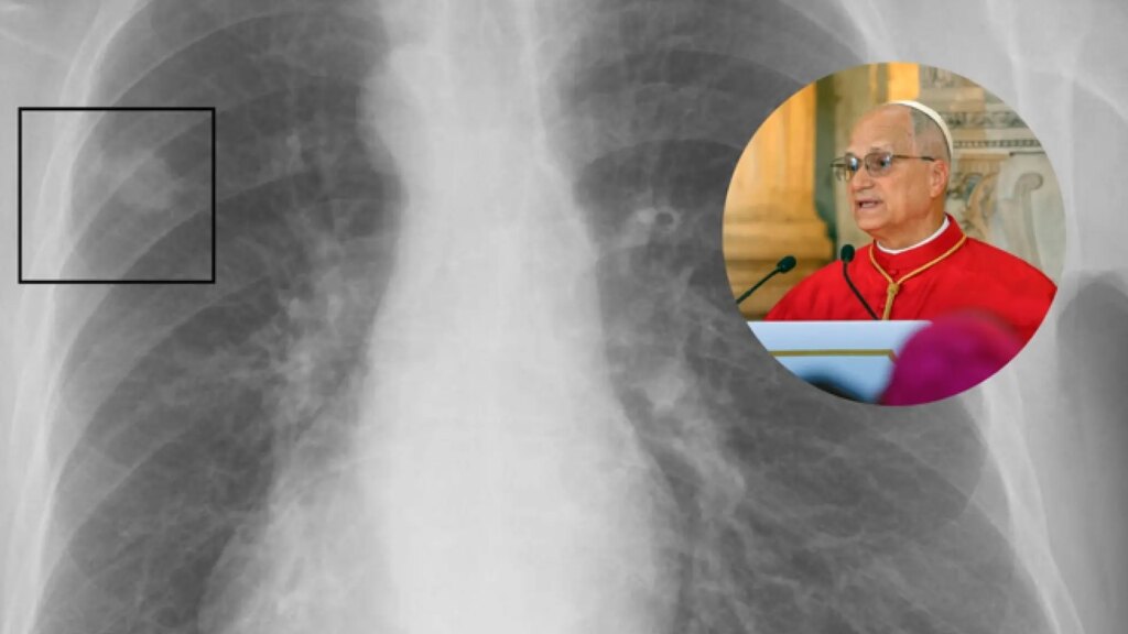 Qué es un nódulo pulmonar, la lesión por la que el Papa León XIV tiene que pasar por quirófano Qué es un nódulo pulmonar, la lesión por la que el Papa León XIV tiene que pasar por quirófano