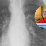 Qué es un nódulo pulmonar, la lesión por la que el Papa León XIV tiene que pasar por quirófano